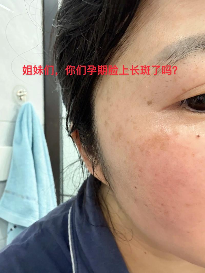 孕期脸上长斑是激素变化导致的必然结果吗？如何有效淡化又不影响胎儿健康？-第1张图片-郑州医学网