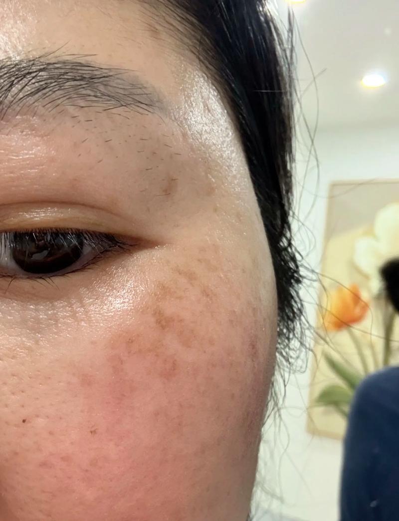 孕期脸上长斑是激素变化导致的必然结果吗？如何有效淡化又不影响胎儿健康？-第2张图片-郑州医学网