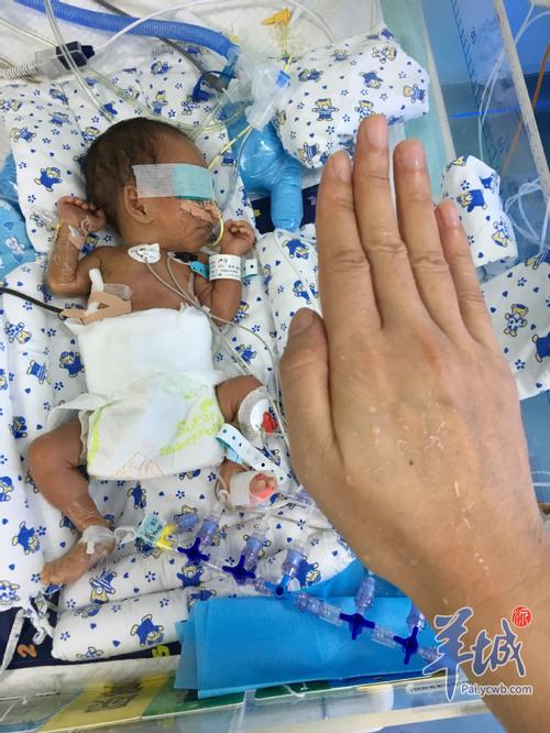 新生儿先天性食道闭锁的成因、早期识别与治疗策略有哪些关键点？-第1张图片-郑州医学网