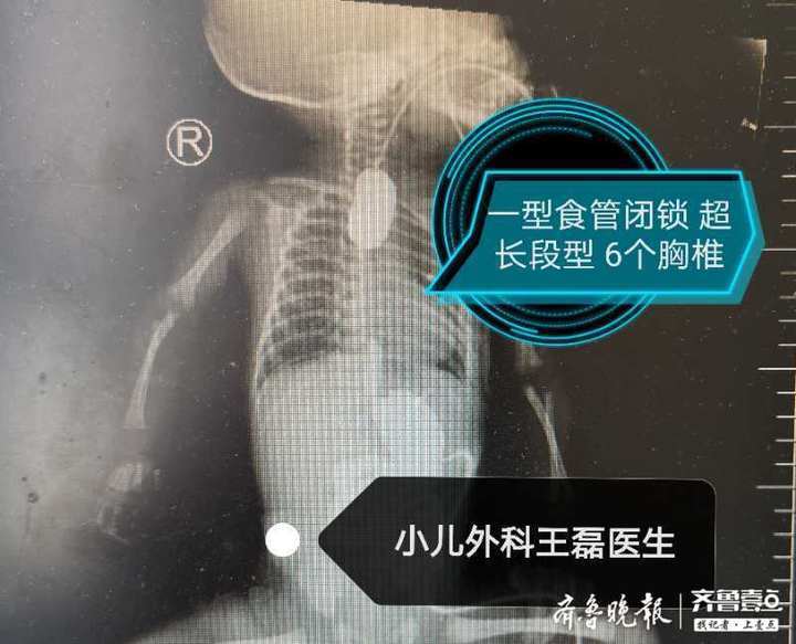 新生儿先天性食道闭锁的成因、早期识别与治疗策略有哪些关键点？-第2张图片-郑州医学网