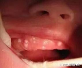 新生儿上颚小白点是什么原因？需要担心吗？-第2张图片-郑州医学网