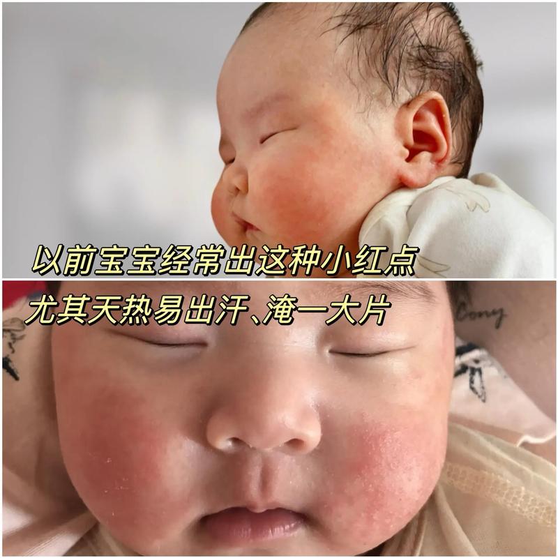 新生儿脸上红血丝多，是正常生理现象还是皮肤疾病信号？-第1张图片-郑州医学网