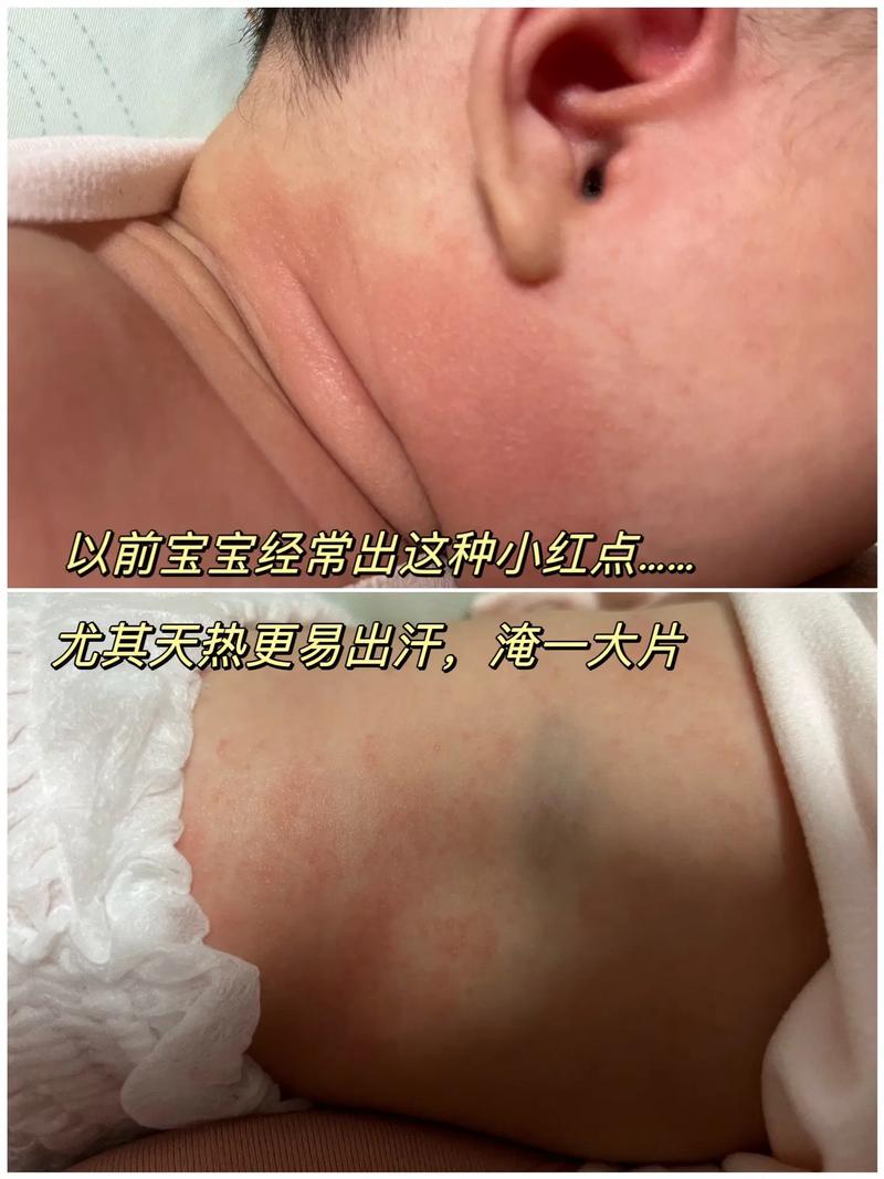 新生儿脸上红血丝多，是正常生理现象还是皮肤疾病信号？-第2张图片-郑州医学网