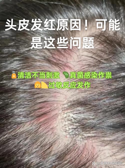 孕期头皮痒是激素变化还是皮肤问题？该怎么缓解才安全？-第3张图片-郑州医学网