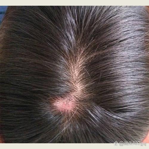 孕期头皮屑增多真的能判断怀女孩吗?科学依据在哪里?-第1张图片-郑州医学网 孕期头皮屑增多真的能判断怀女孩吗?科学依据在哪里?-第1张图片-郑州医学网