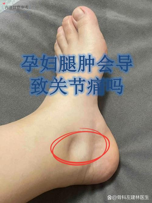 孕期腿肿产后多久能好?水肿消退时间因人而异,如何判断是否正常恢复?-第1张图片-郑州医学网 孕期腿肿产后多久能好?水肿消退时间因人而异,如何判断是否正常恢复?-第1张图片-郑州医学网