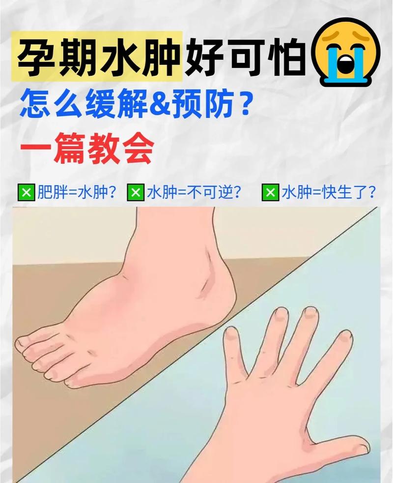 孕期腿肿产后多久能好?水肿消退时间因人而异,如何判断是否正常恢复?-第2张图片-郑州医学网 孕期腿肿产后多久能好?水肿消退时间因人而异,如何判断是否正常恢复?-第2张图片-郑州医学网