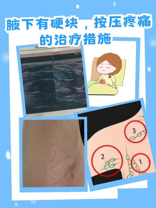 孕期腋窝突然摸到肿块，是孕期正常变化还是需要警惕的信号？-第1张图片-郑州医学网