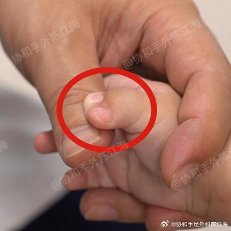 新生儿六指是遗传还是孕期异常?六指畸形会影响发育吗?-第3张图片-郑州医学网 新生儿六指是遗传还是孕期异常?六指畸形会影响发育吗?-第3张图片-郑州医学网