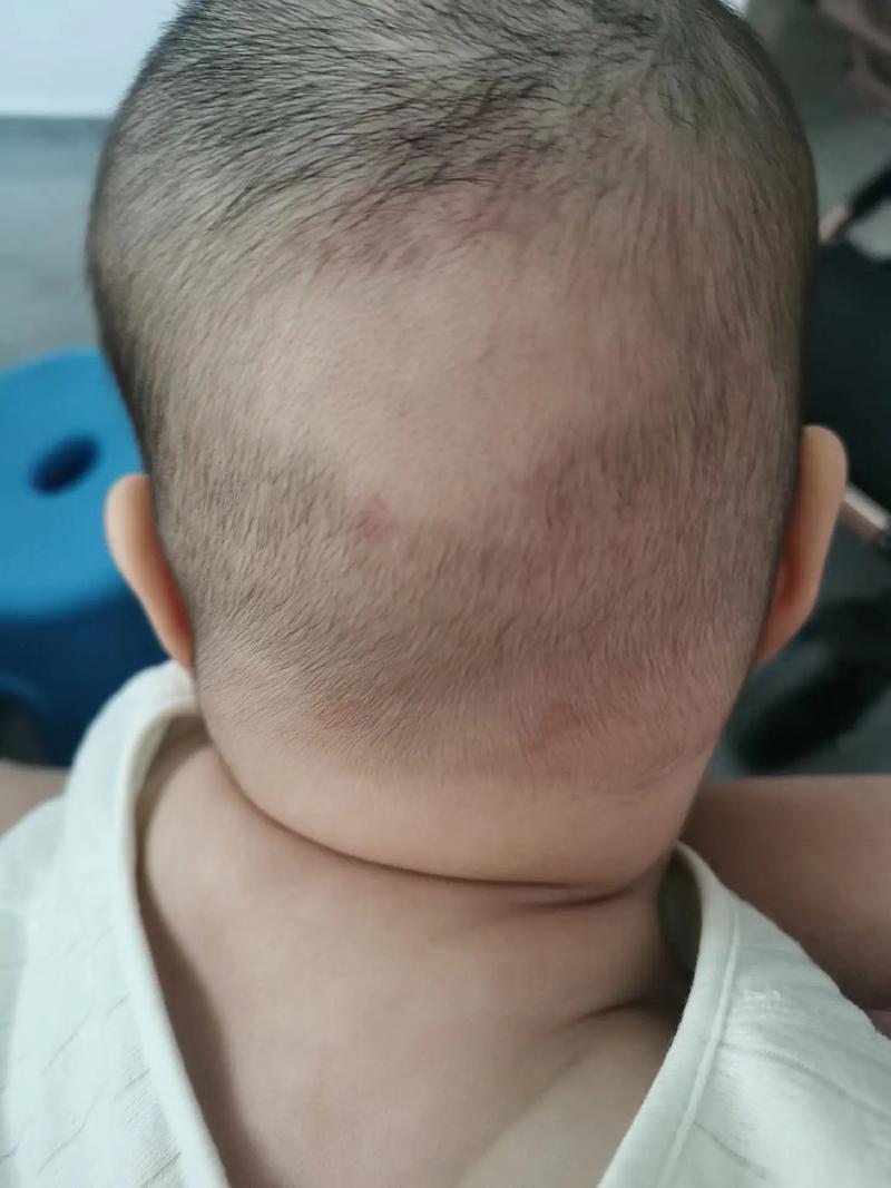 新生儿花斑纹会影响健康发育吗?需要干预治疗吗?-第3张图片-郑州医学网 新生儿花斑纹会影响健康发育吗?需要干预治疗吗?-第3张图片-郑州医学网