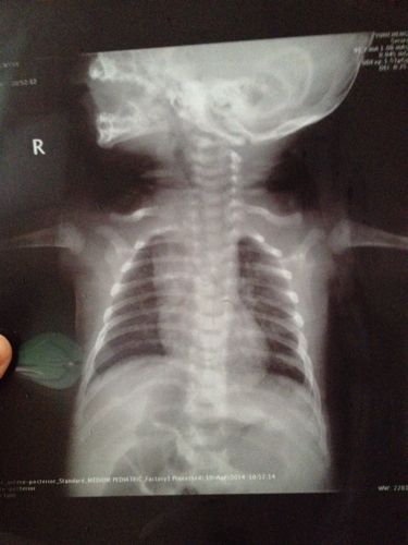 新生儿做胸片检查的辐射剂量究竟有多大？会对宝宝健康造成潜在风险吗？-第2张图片-郑州医学网