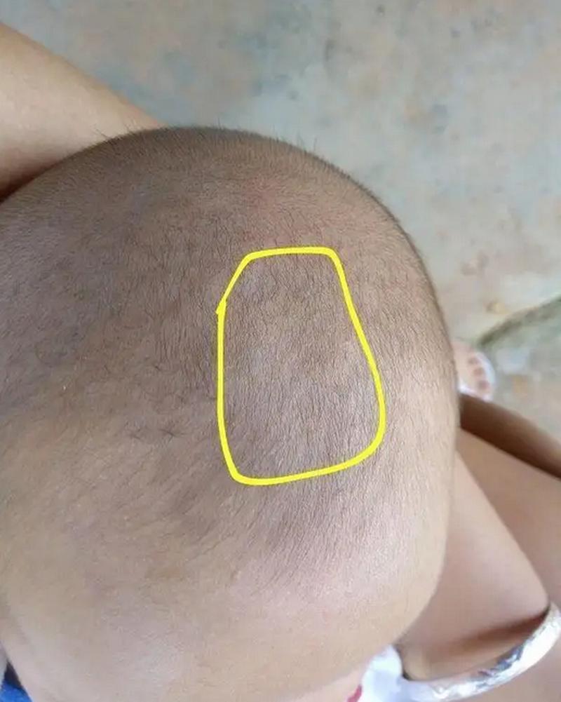 新生儿头顶卤门不跳动是正常现象还是异常信号？需警惕哪些潜在问题？-第1张图片-郑州医学网