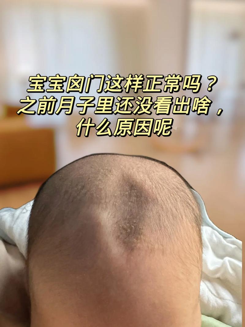新生儿头顶卤门不跳动是正常现象还是异常信号？需警惕哪些潜在问题？-第2张图片-郑州医学网