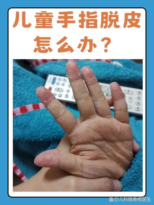 儿童手指头脱皮怎么办-第1张图片-郑州医学网