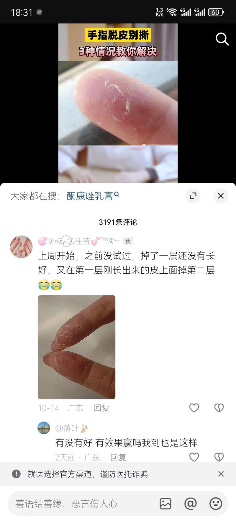 儿童手指头脱皮怎么办-第3张图片-郑州医学网