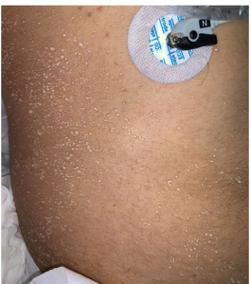 新生儿晶痱一般多久能消退？需要家长注意哪些护理事项来帮助消退？-第2张图片-郑州医学网