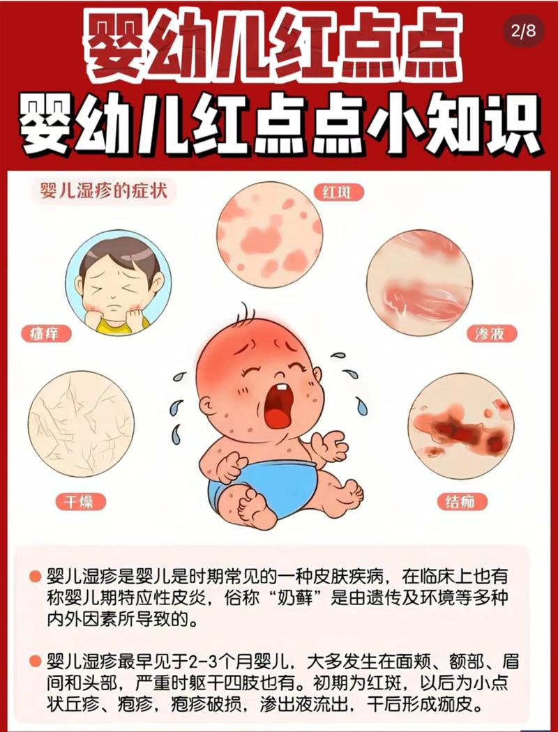 新生儿晶痱一般多久能消退？需要家长注意哪些护理事项来帮助消退？-第3张图片-郑州医学网