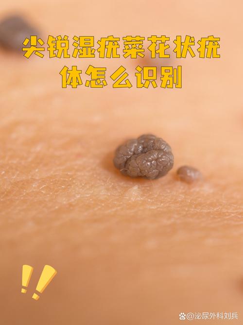 孕期尖锐湿庞怎么治疗-第3张图片-郑州医学网