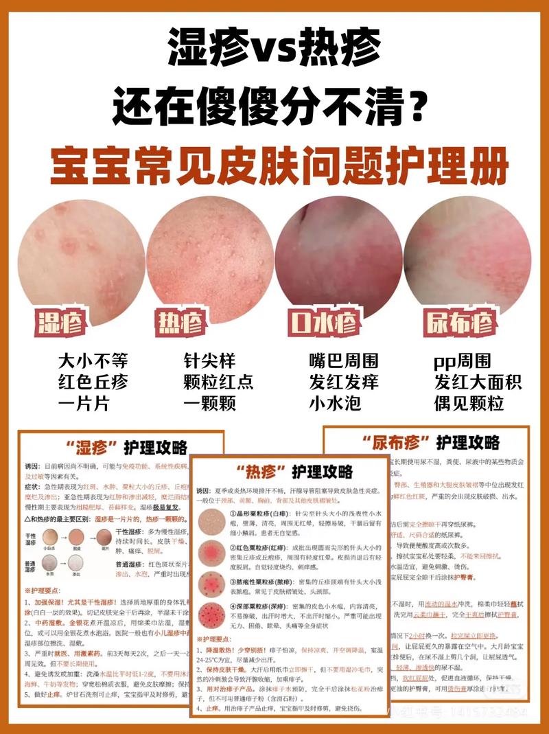 新生儿热疹反复发作难消退？科学护理与正确处理方法有哪些？-第1张图片-郑州医学网