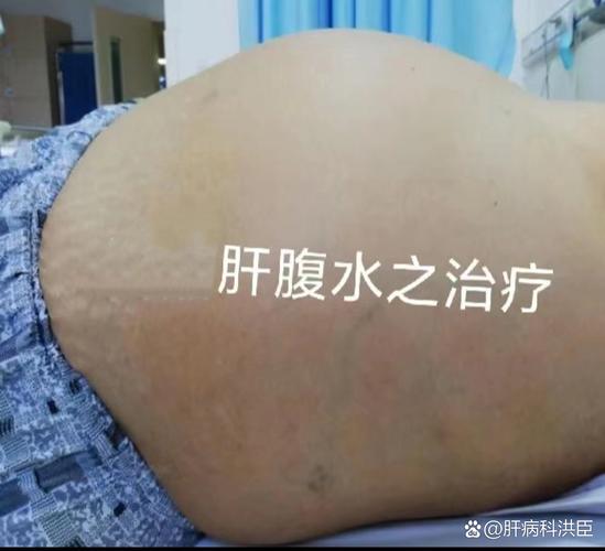 新生儿肝硬化患者生存期究竟有多长？影响因素与治疗前景如何？-第2张图片-郑州医学网