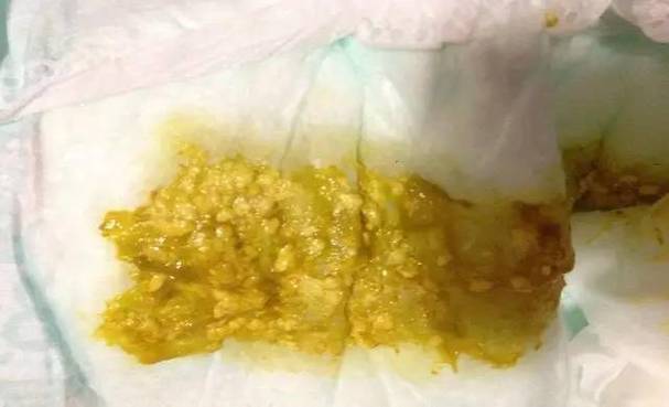 新生儿大便有粘液和奶瓣是消化不良还是生病了？-第3张图片-郑州医学网