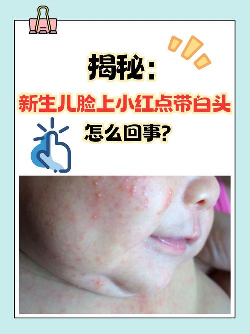 新生儿脸上有小红斑点是正常现象还是需要警惕的健康信号？-第1张图片-郑州医学网