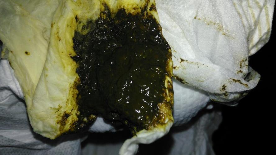 新生儿10天大便黑色是正常情况还是需要警惕的健康信号?-第3张图片-郑州医学网 新生儿10天大便黑色是正常情况还是需要警惕的健康信号?-第3张图片-郑州医学网