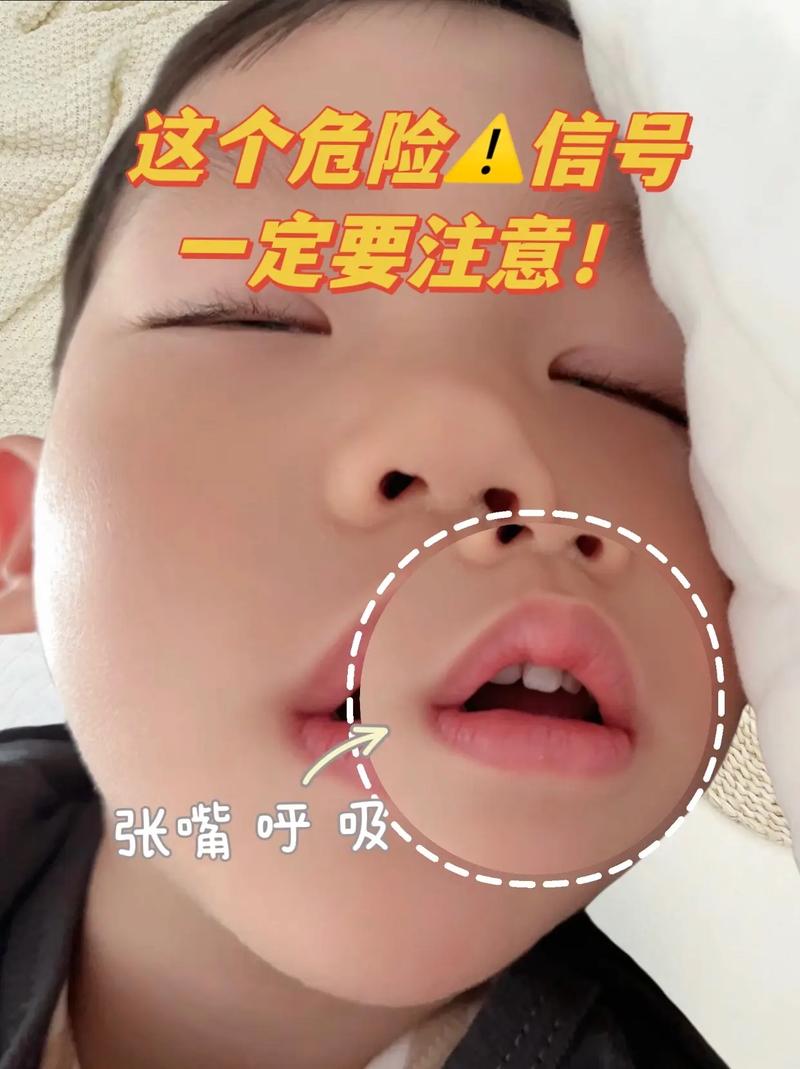 新生儿颜面挤压综合征，产道挤压会导致面部畸形吗？如何预防与处理？-第2张图片-郑州医学网