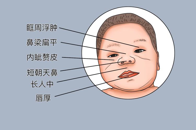 新生儿颜面挤压综合征，产道挤压会导致面部畸形吗？如何预防与处理？-第3张图片-郑州医学网