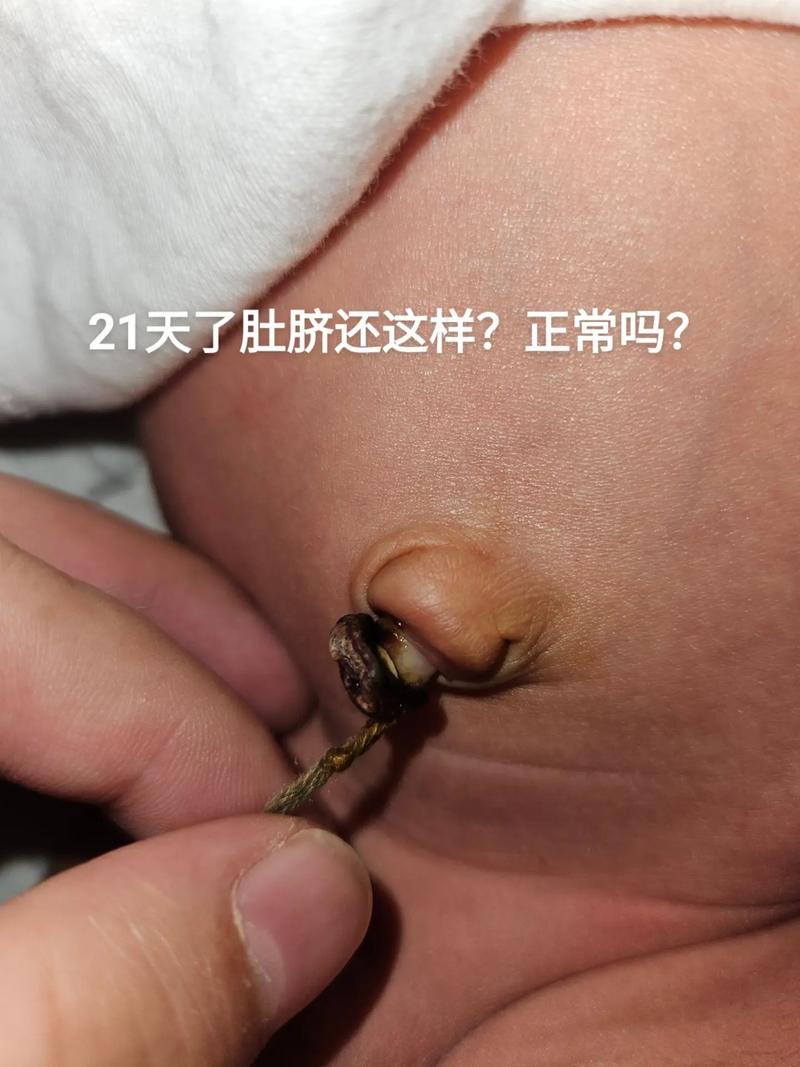 新生儿肚脐有臭味是感染了吗？该怎么护理才能避免问题？-第1张图片-郑州医学网