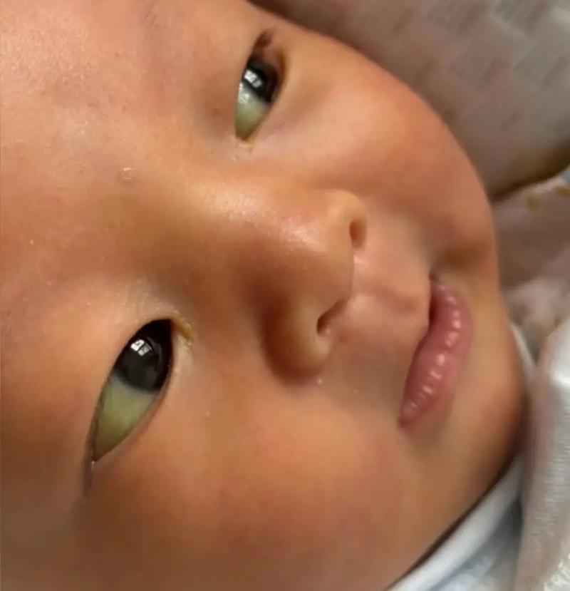 新生儿鼻子发黄一定是黄疸吗？需要区分生理性还是病理性原因吗？-第1张图片-郑州医学网