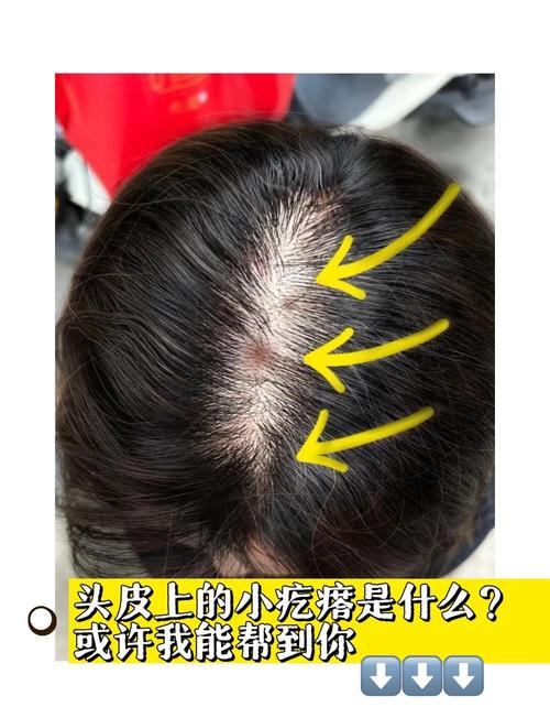 孕期头皮痘痘频发又不敢用药,这到底该怎么办才安全?-第1张图片-郑州医学网 孕期头皮痘痘频发又不敢用药,这到底该怎么办才安全?-第1张图片-郑州医学网