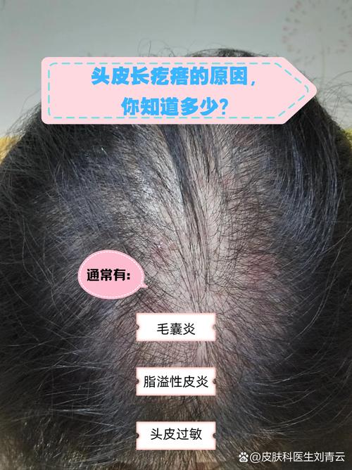 孕期头皮痘痘频发又不敢用药，这到底该怎么办才安全？-第2张图片-郑州医学网