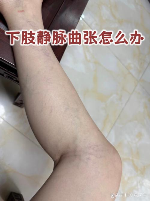 孕期静脉曲张产后能自行恢复吗？需要哪些干预措施才能改善？-第2张图片-郑州医学网