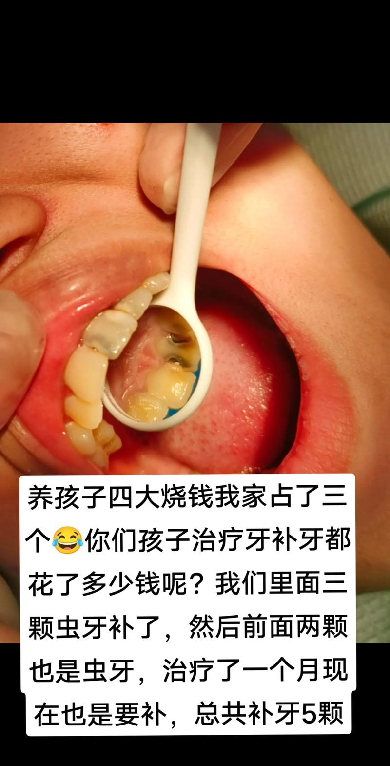 儿童补牙一颗牙费用差异大，不同材质、地区价格差多少？家长该如何选择？-第2张图片-郑州医学网