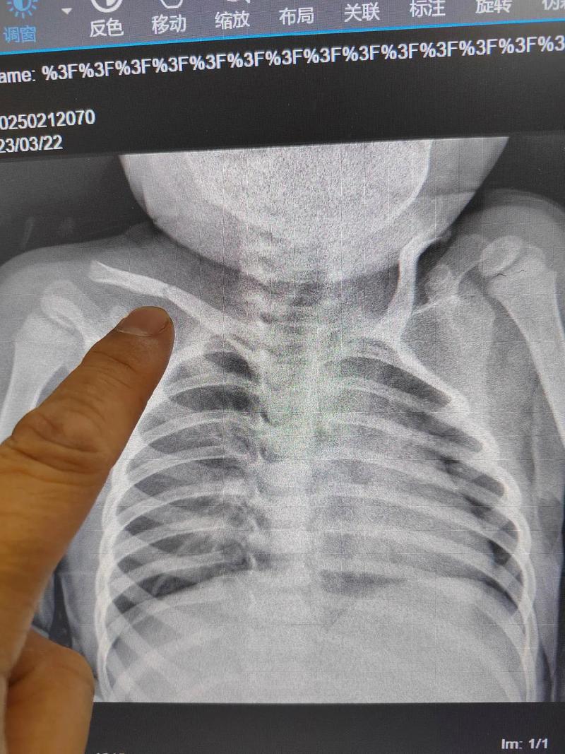 新生儿锁骨不对称图片是正常现象吗？需要就医检查吗？-第1张图片-郑州医学网