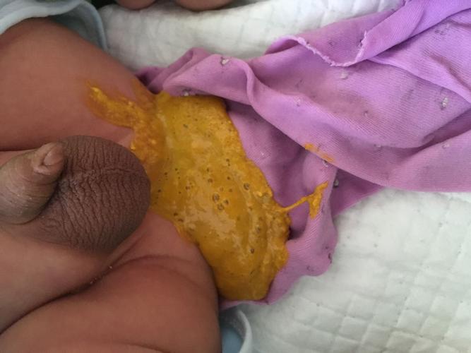 新生儿粑粑有泡泡是消化不良还是乳糖不耐受？新手爸妈该如何判断和处理？-第1张图片-郑州医学网