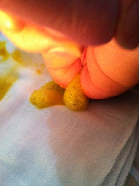 新生儿粑粑有泡泡是消化不良还是乳糖不耐受？新手爸妈该如何判断和处理？-第2张图片-郑州医学网