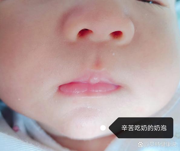 新生儿嘴上的白泡是正常现象吗？需要处理吗？附图片对比一下？-第1张图片-郑州医学网