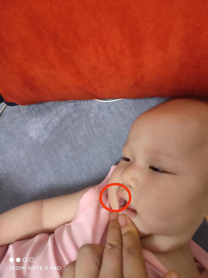 新生儿嘴上的白泡是正常现象吗？需要处理吗？附图片对比一下？-第2张图片-郑州医学网