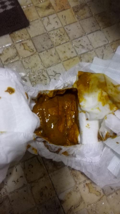 新生儿大便出现丝条状物是正常现象还是消化异常信号?-第3张图片-郑州医学网 新生儿大便出现丝条状物是正常现象还是消化异常信号?-第3张图片-郑州医学网