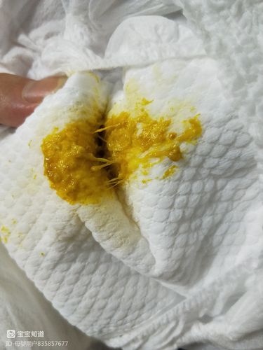 新生儿大便出现丝条状物是正常现象还是消化异常信号?-第2张图片-郑州医学网 新生儿大便出现丝条状物是正常现象还是消化异常信号?-第2张图片-郑州医学网
