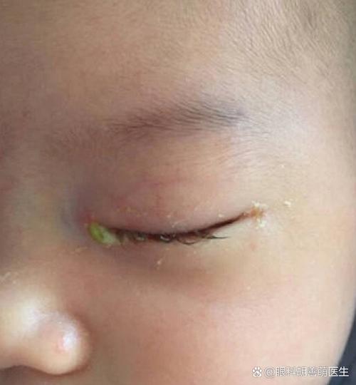 新生儿黄疸眼睛会发黄吗?这可能是哪些信号在警示?-第1张图片-郑州医学网 新生儿黄疸眼睛会发黄吗?这可能是哪些信号在警示?-第1张图片-郑州医学网