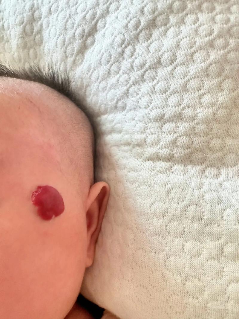 新生儿血管瘤早期症状有哪些?家长该如何识别和应对?-第3张图片-郑州医学网 新生儿血管瘤早期症状有哪些?家长该如何识别和应对?-第3张图片-郑州医学网