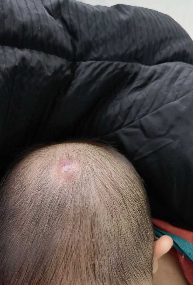 新生儿头皮血管瘤图片长什么样?不同类型有什么区别?需要治疗吗?-第1张图片-郑州医学网 新生儿头皮血管瘤图片长什么样?不同类型有什么区别?需要治疗吗?-第1张图片-郑州医学网
