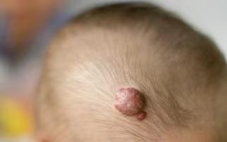 新生儿头皮血管瘤图片长什么样?不同类型有什么区别?需要治疗吗?-第2张图片-郑州医学网 新生儿头皮血管瘤图片长什么样?不同类型有什么区别?需要治疗吗?-第2张图片-郑州医学网