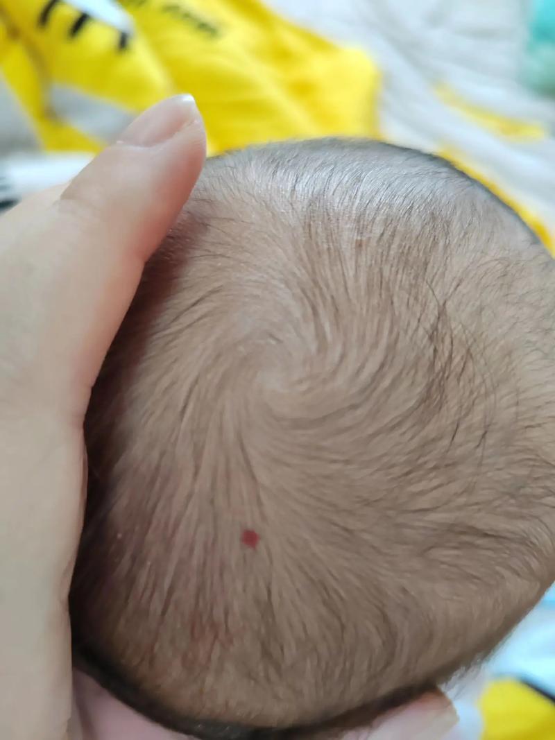 新生儿头皮血管瘤图片长什么样?不同类型有什么区别?需要治疗吗?-第3张图片-郑州医学网 新生儿头皮血管瘤图片长什么样?不同类型有什么区别?需要治疗吗?-第3张图片-郑州医学网