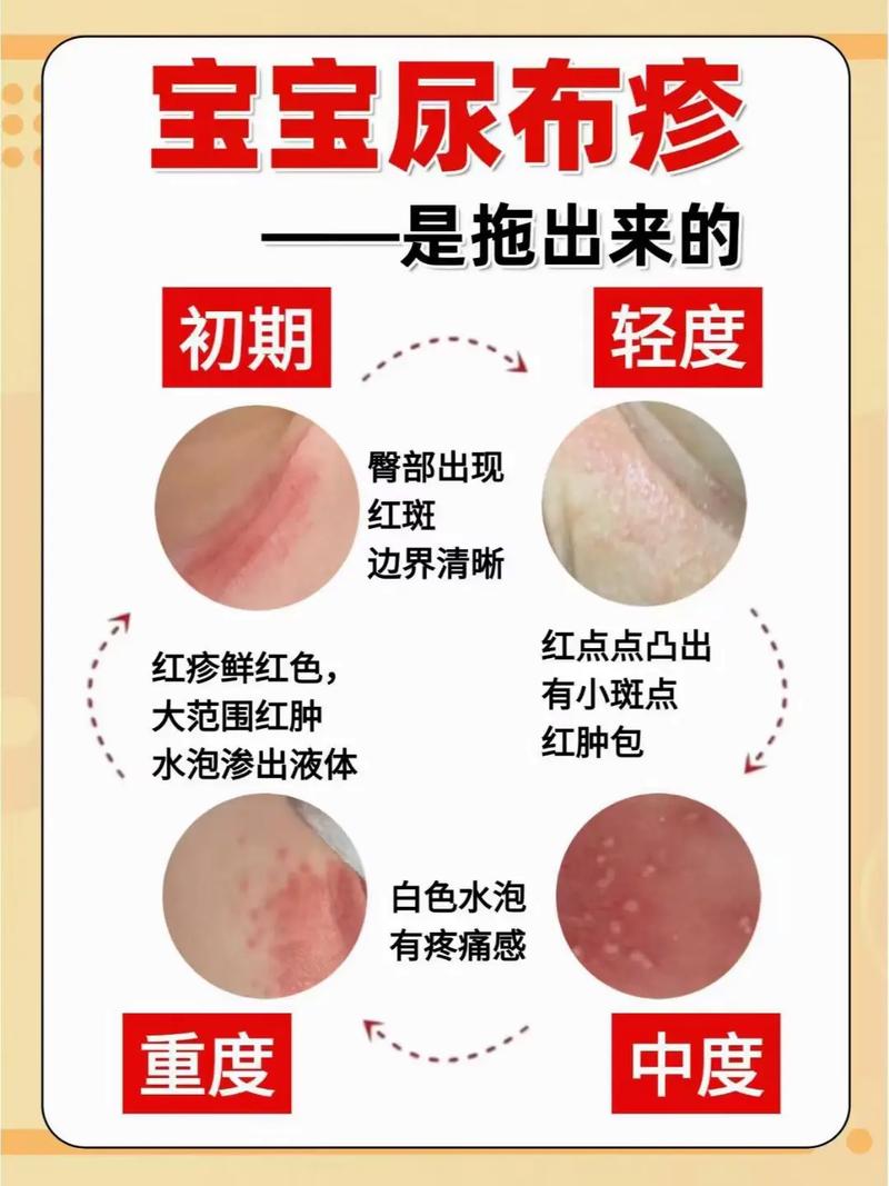 新生儿尿路感染的症状-第3张图片-郑州医学网