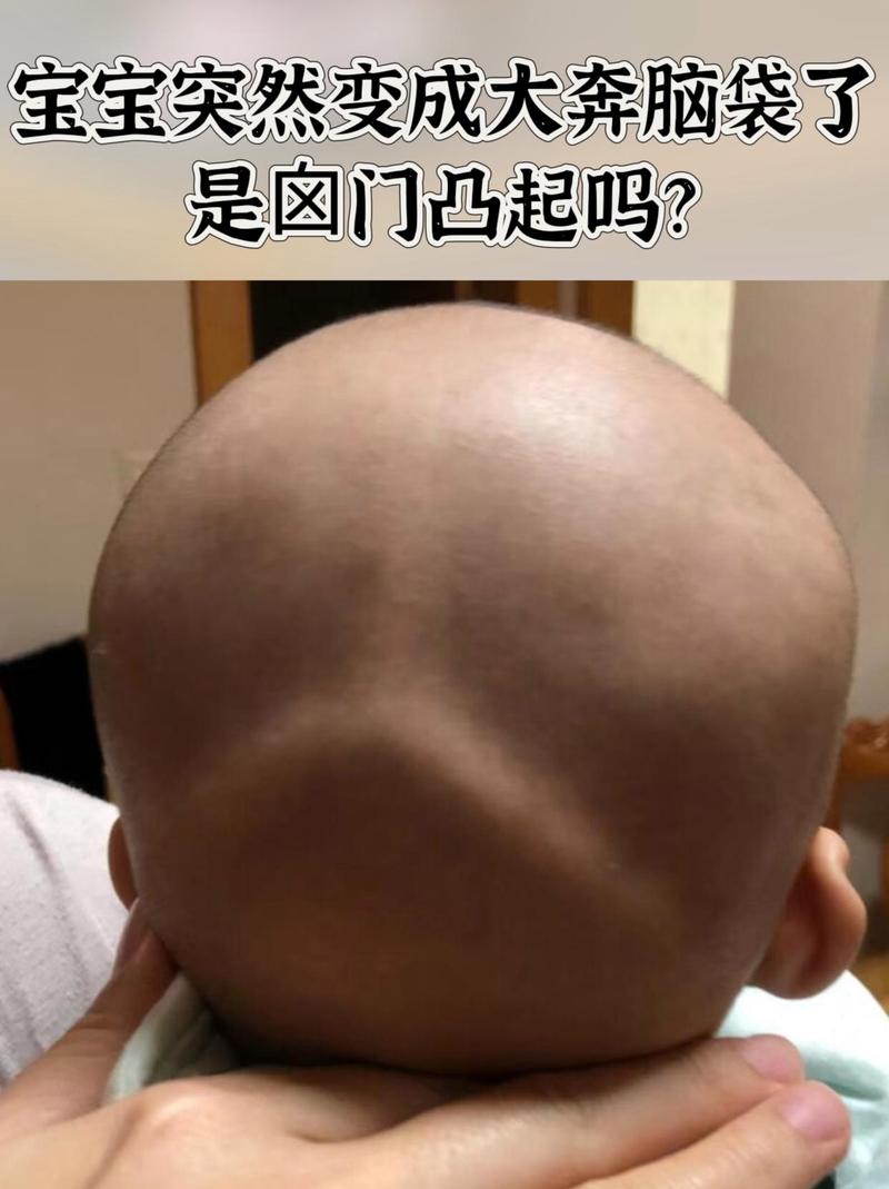 新生儿后脑勺骨头不平是缺钙还是发育异常？需要干预吗？-第2张图片-郑州医学网