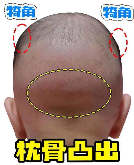 新生儿后脑勺骨头不平是缺钙还是发育异常？需要干预吗？-第3张图片-郑州医学网